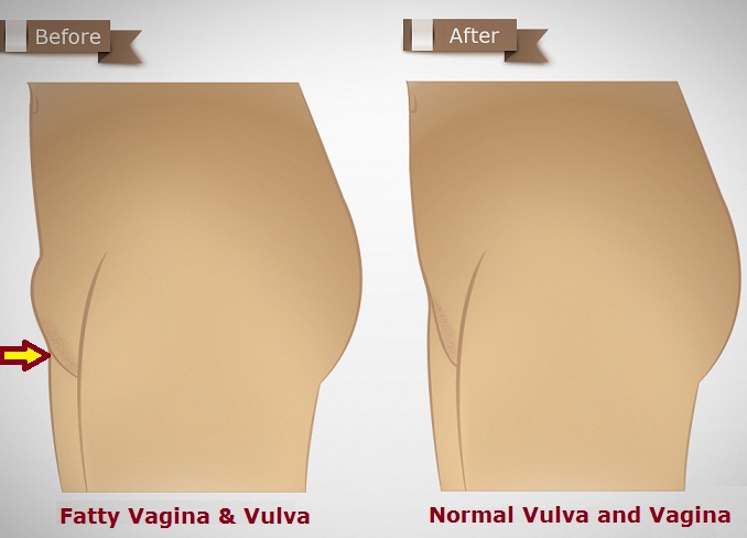 tips to lose vulva and vagina fat fast